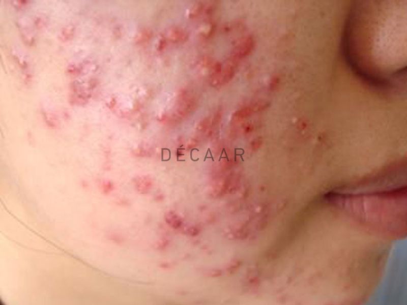 mụn trứng cá bọc
